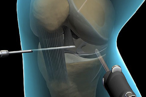  Artroscopia de rodilla