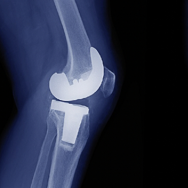 Prótesis total de Rodilla