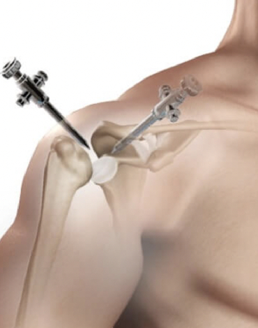 Artroscopia de hombro
