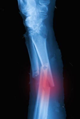Fractura de Muñeca o Antebrazo
