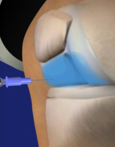 Infiltraciones Articulares