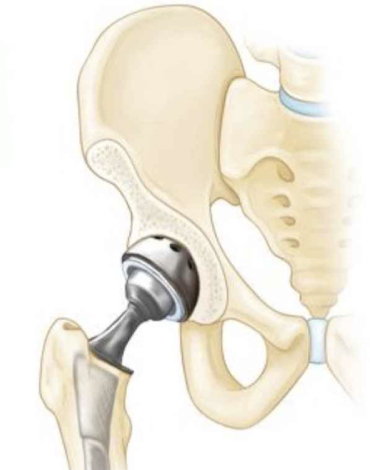 Colocación de Prótesis total de Cadera