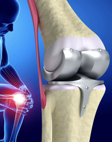 Colocación de Prótesis total de rodilla